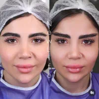 جدیدترین متد لیفت ابرو