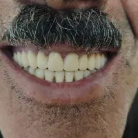 دندان مصنوعی|آرایشی، بهداشتی، درمانی|لردگان, |دیوار