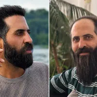 کاشت مو پرتراکم اقساطی وتخفیف آبان ماه