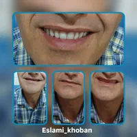 خدمات تخصصی پروتز متحرک(دندان مصنوعی)|خدمات آرایشگری و زیبایی|قزوین, |دیوار