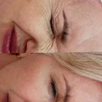 ژل فیلر بوتاکس انزیم|خدمات آرایشگری و زیبایی|خرم‌آباد, |دیوار