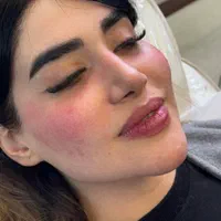 جشنواره تزریق ژل بوتاکس(قیمت پایین کیفیت بالا)|خدمات آرایشگری و زیبایی|اصفهان, جلفا|دیوار