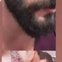 کاشت ریش طبیعی با شرایط اقساطی|خدمات زیبایی و سلامت|تبریز, |دیوار