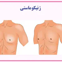 راهنمایی در مورد ژنیکوماستی