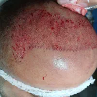 کاشت موی طبیعی فول تراکم