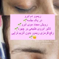 ریموو،پاک کردن تتوی صورت|خدمات آرایشگری و زیبایی|دوگنبدان, |دیوار