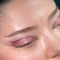 بلفارو ۸۹۰۰ در بیمارستان شرایط استریل بلفاروپلاستی