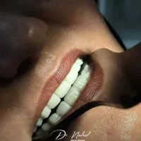دندانپزشکی/کامپوزیت دیجیتال/ ایمپلنت/عصب کشی