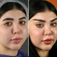 آف بلک فرایدی تزریق ژل بوتاکس فیلر ریمو تتو...|خدمات آرایشگری و زیبایی|علیآباد کتول, |دیوار