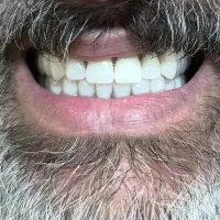 دندان مصنوعی/طرح لمینت/اوردنچر/کروم کبالت