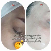 لک جوش و منافذ و جای جوش و لیفت و جوانسازی صورت|خدمات آرایشگری و زیبایی|زاهدان, |دیوار