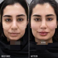ژل لب بوتاکس فیلر انزیم ساکشن غبغب گونه زاویه سازی|خدمات آرایشگری و زیبایی|مشهد, سجاد شهر|دیوار