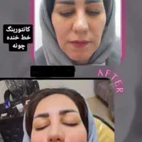 فیلر لب زیر چشم فیلر بادی نخ لیفت پی ار پی مزو|خدمات آرایشگری و زیبایی|اصفهان, سیچان|دیوار