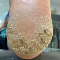 پدیکور  روسی برای پاهای آسیب دیده