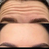 تخفیف ویژه میکرووژل بوتاکس|خدمات آرایشگری و زیبایی|بیرجند, |دیوار