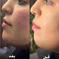 ژل بوتاکس مزوتراپی prp با قیمت استثنائی توسط پزشک