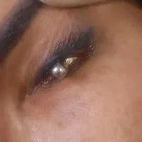 ریمو و پاک کردن تاتو با لیزر