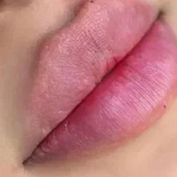 تخفیف ژل و بوتاکس برای آقایون و خانمها