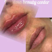 جشنواره تابستانه بوتاکس خال لاغری مزو‌ موفرسیما|خدمات آرایشگری و زیبایی|همدان, |دیوار