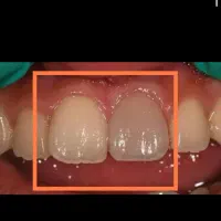 عصبکشی اندو دندان جلو۱۲۳تعرفه دولتی|خدمات آرایشگری و زیبایی|قم, زنبیل آباد|دیوار