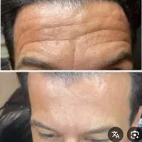 اف 10درصدی ژل و بوتاکس|خدمات آرایشگری و زیبایی|اهواز, فاز ۲ پادادشهر|دیوار