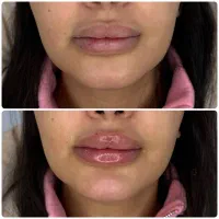 تزریق فیلر (ژل) بوتاکس مزو  در کلینیک ونوس با قی|خدمات آرایشگری و زیبایی|تهران, حر|دیوار