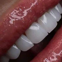 کامپوزیت دندان