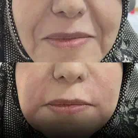 مرکز لیفت هایفو سنندج (فیلرژل)