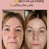 جوانسازی صورت بدون جراحی با تخفیف ویژه|خدمات آرایشگری و زیبایی|تهران, اقدسیه|دیوار