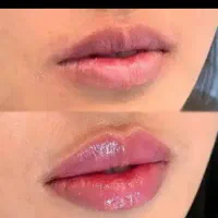 جشنواره تابستانی خدمات زیبایی ژل و بوتاکس
