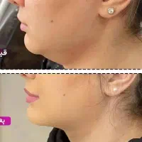 مزو رشدمو لاغری کاملارایگان،ژل بوتاکس انزیم|خدمات آرایشگری و زیبایی|قم, زنبیل آباد|دیوار