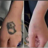 پاک کردن تتو و خالکوبی با دستگاه لیزر|خدمات آرایشگری و زیبایی|زنجان, |دیوار