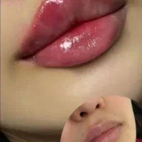 ژل لب و ژل گونه و زاویه سازیو فول فیس توسط پزشک