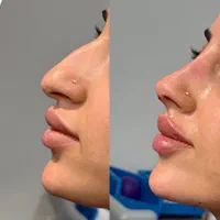 آنزیم ترکیبی بینی گوشتی،لیفت بینی،ژل لب،مزوتراپی|خدمات آرایشگری و زیبایی|تهران, سعادت‌آباد|دیوار