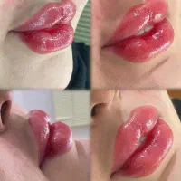 تزریق ژل فیلربوتاکس تخفیفات50درصدی برای زیباجویان