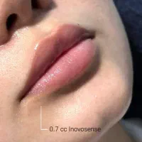 فیلربادی.هیپ دیپ.فیلر.بوتاکس
