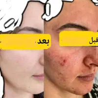 کرم از بین بردن لک ها و جای جوش
