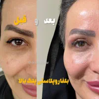 حذف پف پلک و افتادگی بوتاکس،ژل،بوکال،سانترال،هایفو