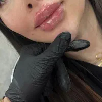 تزریق ژل لب گونه چونه فیلر زاویه فک خط خنده فقط۵۸۰