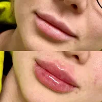 فیلر/ژل/بوتاکس/فیشیال