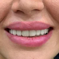 دندان مصنوعی،ایمپلنت، لمینیت،با شرایط اقساط ویژه|خدمات آرایشگری و زیبایی|تهران, مجیدیه|دیوار