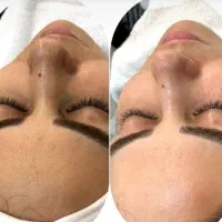 خدمات تخصصی پوست و زیبایی صورت ۵۰٪آف تا فردا|خدمات آرایشگری و زیبایی|مشهد, دانشجو|دیوار