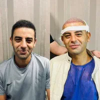 کاشت مو با جدیدترین روش و شرایط اقساطی