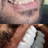 دندانپزشکی ایمپلنت لیزرژل عصب کشی کشیدن روکش جراحی|خدمات زیبایی و سلامت|تهران, چهارصد دستگاه|دیوار