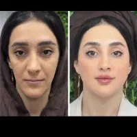 شنبه/فیلرگونه/چانه/کانتورینگ/توسط پزشک