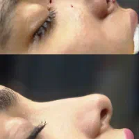 جراحی بینی با متد جدید وقیمت مناسب