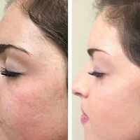 تخفیف فوق العاده خدمات ژل و بوتاکس در مطب|خدمات آرایشگری و زیبایی|شاهینشهر, بوستان حافظ|دیوار