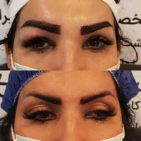 کاشت مو.ابرو.ریش درکیلنیک تخصصی|خدمات آرایشگری و زیبایی|قم, باجک دو|دیوار