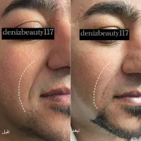 جشنواره تزریق ژل و بوتاکس (توسط پزشک)|خدمات آرایشگری و زیبایی|اصفهان, عباسآباد|دیوار