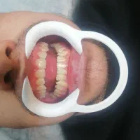 کامپوزیت دندان هر فک 5تومن|خدمات آرایشگری و زیبایی|محمدشهر, محمدشهر|دیوار